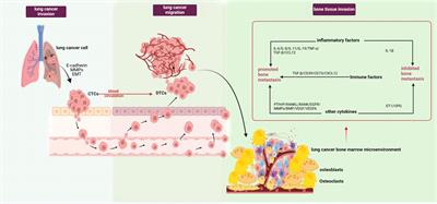 Bone marrow adipocytes and lung cancer bone metastasis: unraveling the role of adipokines in the tumor microenvironment